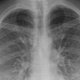A chest X-ray taken of a early victim of EVALI in Utah